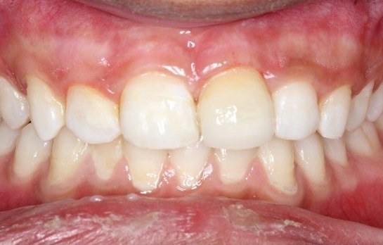 Smile restoration, after treatment