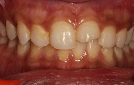 Smile restoration, before treatment