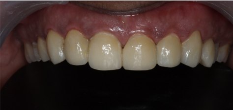 Ceramic crowns, after treatment