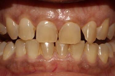 Ceramic crowns, before treatment