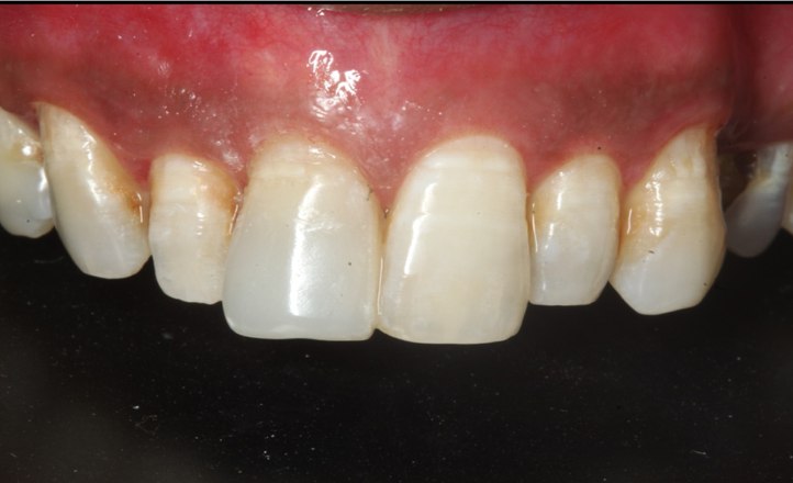 Chipped tooth restoration, after treatment