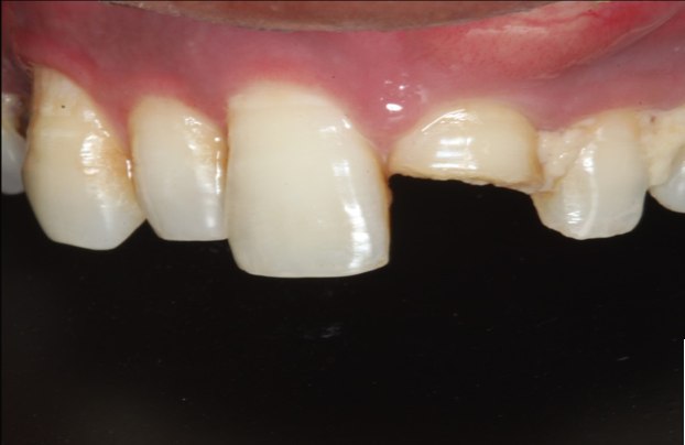 Chipped tooth restoration, before treatment