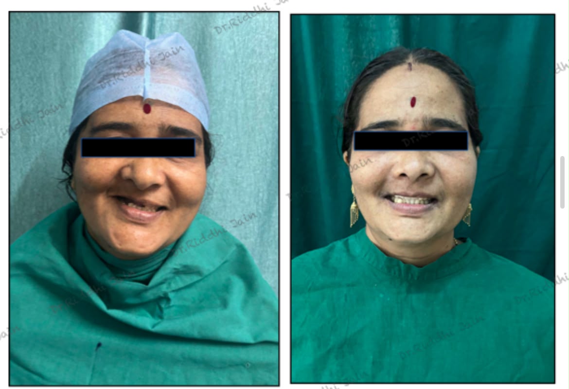 Smile makeover, before and after treatment