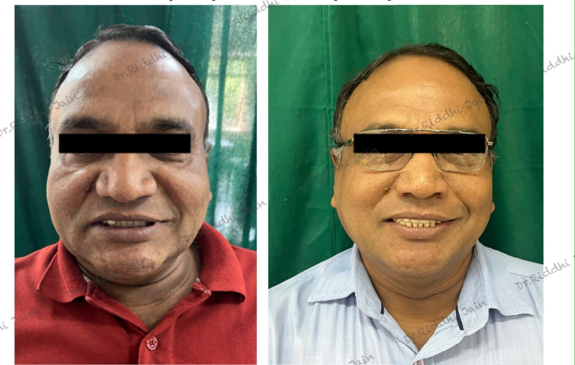 Full-mouth rehabilitation, before and after treatment