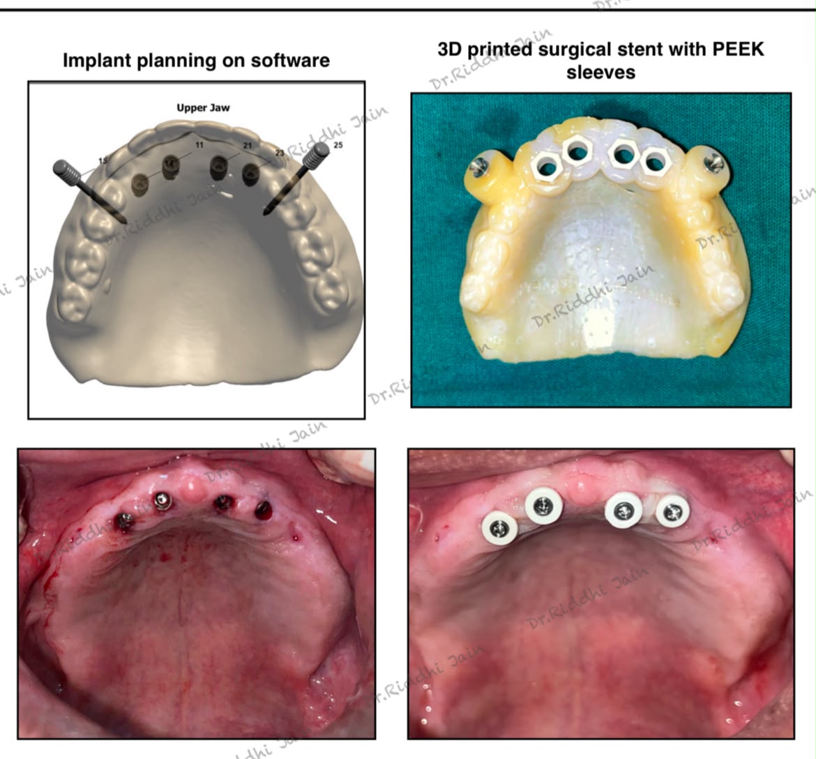 Full-arch implant planning, before and after treatment