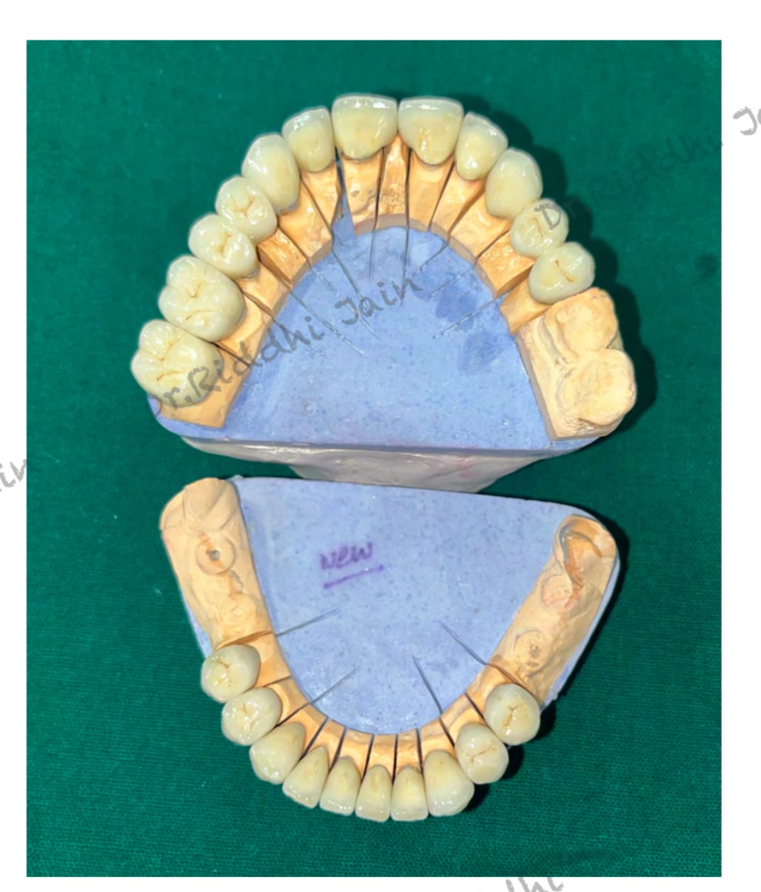Custom full-mouth ceramics, before and after treatment