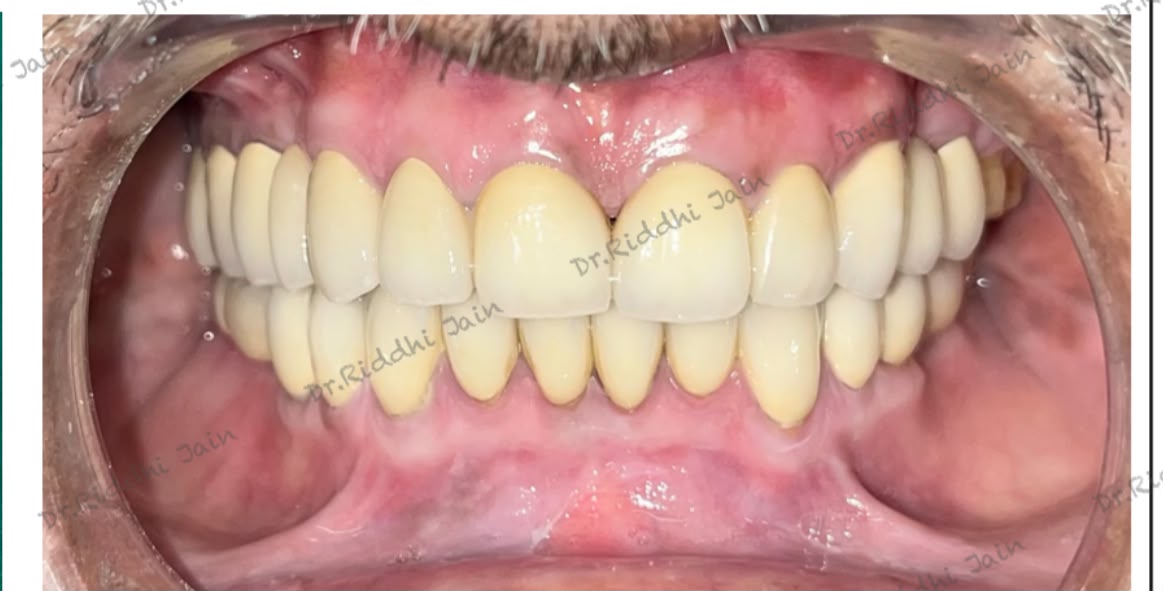 Full-mouth implant rehabilitation, before and after treatment