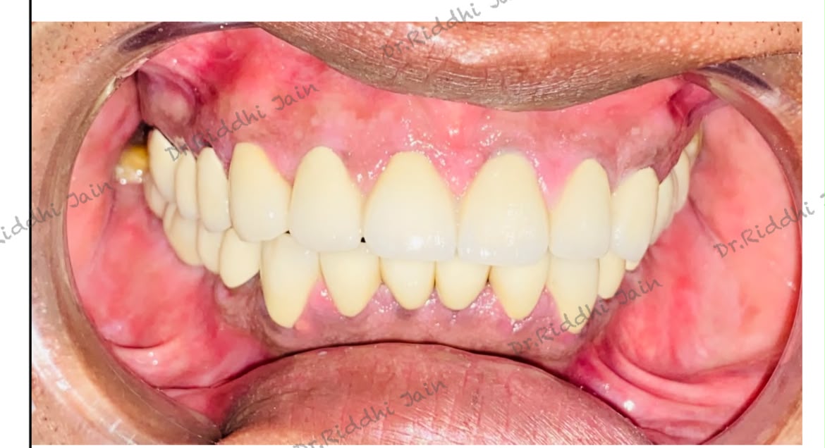 Full-mouth smile rehabilitation, after treatment