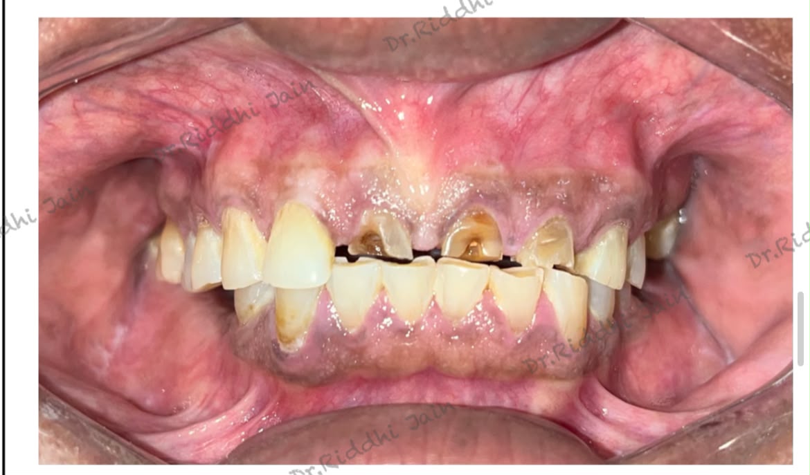 Full-mouth smile rehabilitation, before treatment