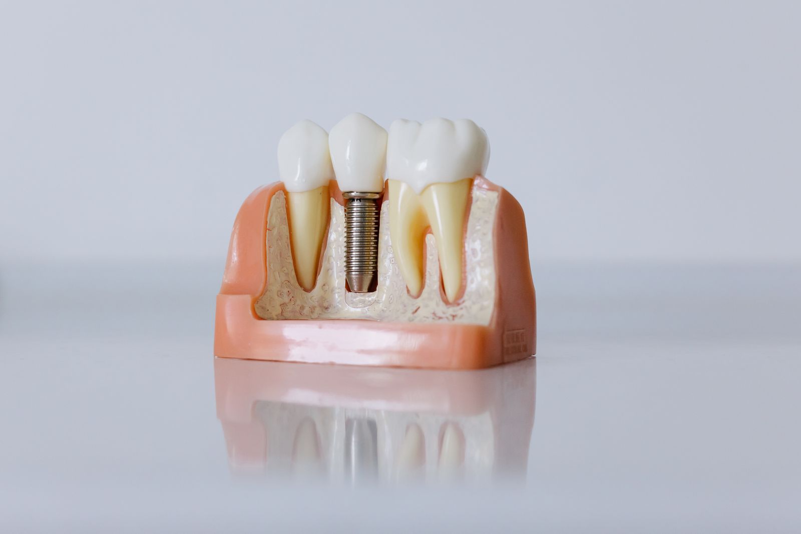 A dental implant model showing how a titanium implant replaces a tooth